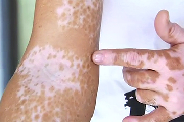 O que Ã© vitiligo?